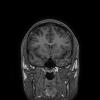 3T Neuro Images -Coronal FSPGR BRAVO Human Head TE = 3.2 TR = 8.5