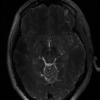 7T Neuro Images - Axial T2 CUBE Human Head TE = 77.7 TR = 2500.0