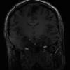 7T Neuro Images - Coronal T1 BRAVO Human Head TE = 2.4 TR = 6.3