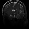 7T Neuro Images - Coronal T2 CUBE Human Head TE = 77.7 TR = 2500.0