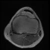 7T Ortho Images - SC-Axial T1 ARC Human Knee TE = 11.2 TR = 1125.0