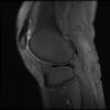 7T Ortho Images - Sagittal T2 FS Human Knee TE = 62.9 TR = 5000.0