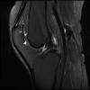 7T Ortho Images - Sagittal T2 FS Human Knee TE = 62.9 TR = 5000.0