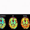 Human brain T1ρ measurements across a pH spectrum.  (A) T1ρ maps of the human brain varied with end-tidal CO2 concentration (EtCO2) during the 5% CO2, room air, and hyperventilation conditions. The intensity maps represent T1ρ times ranging between 0ms (b