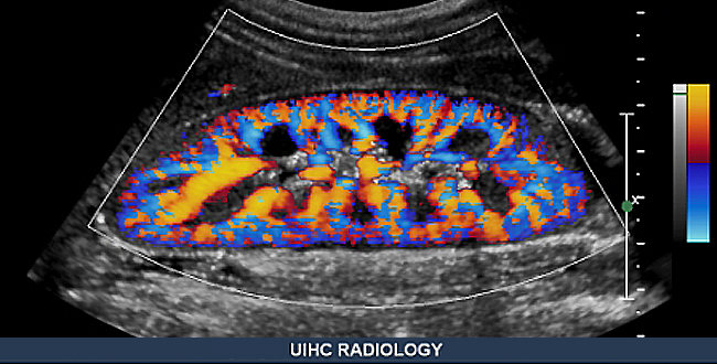 Sonography of a kidney