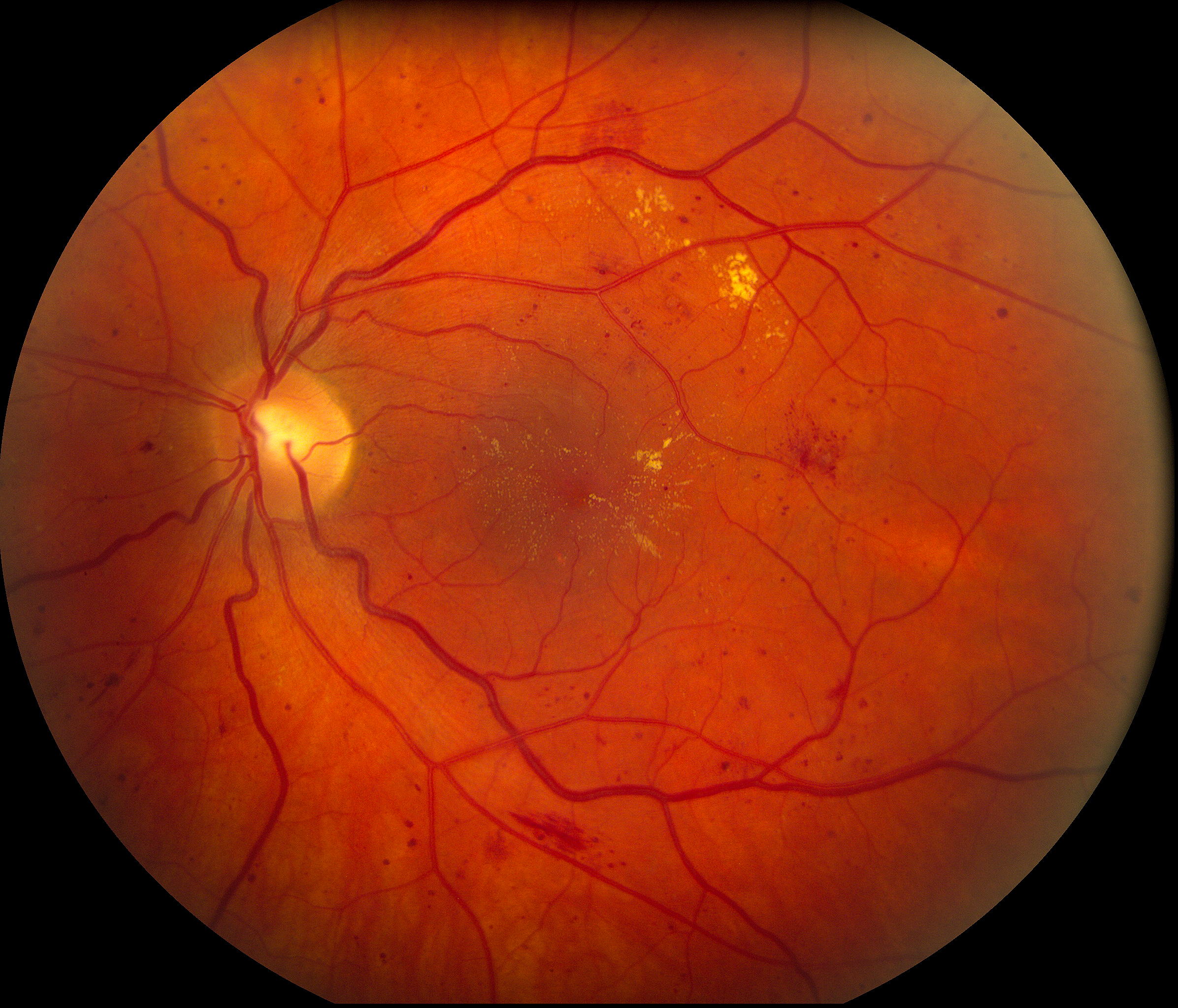 About diabetic retinopathy | Carver College of Medicine