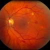Nonproliferative diabetic retinopathy