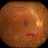 proliferative diabetic retinopathy