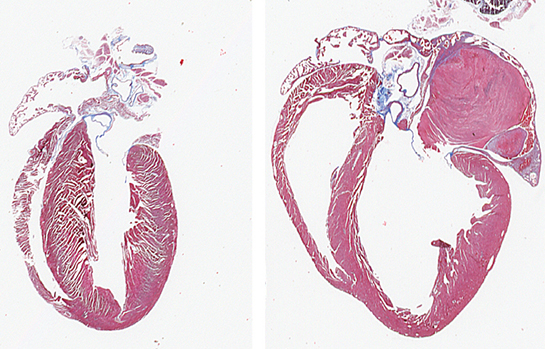 Heart Failure Example