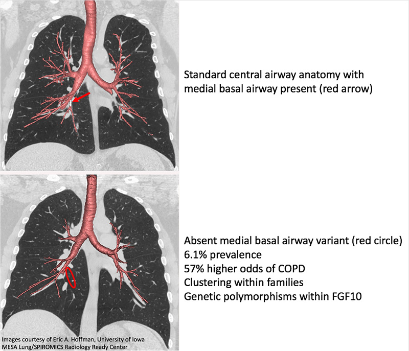 Side by side figures showing lung anatomy variations