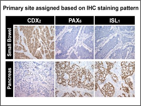 Chart for the primary site assigned based on IHC staining pattern