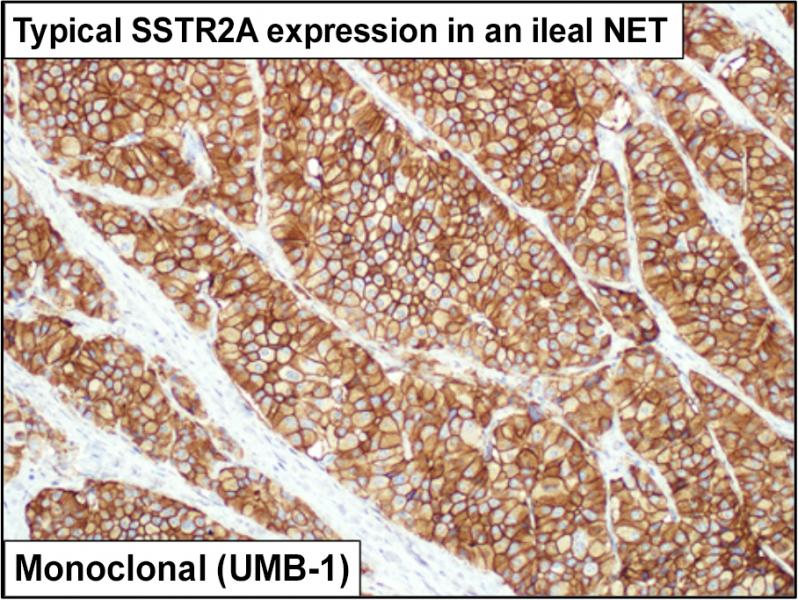 Typical SSTR2A expression in an ileal NET