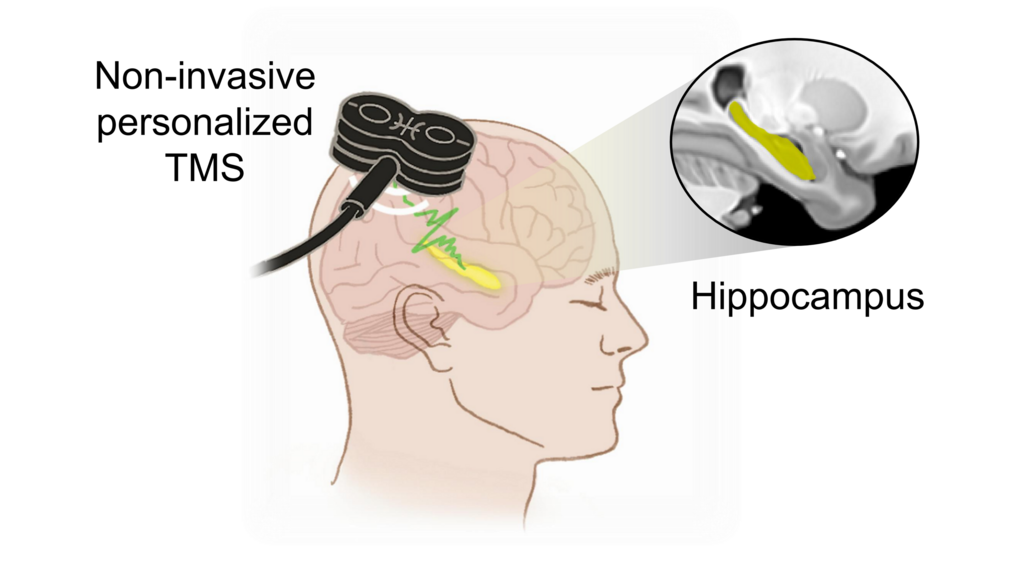Graphic depicting non-invasive personalized TMS.